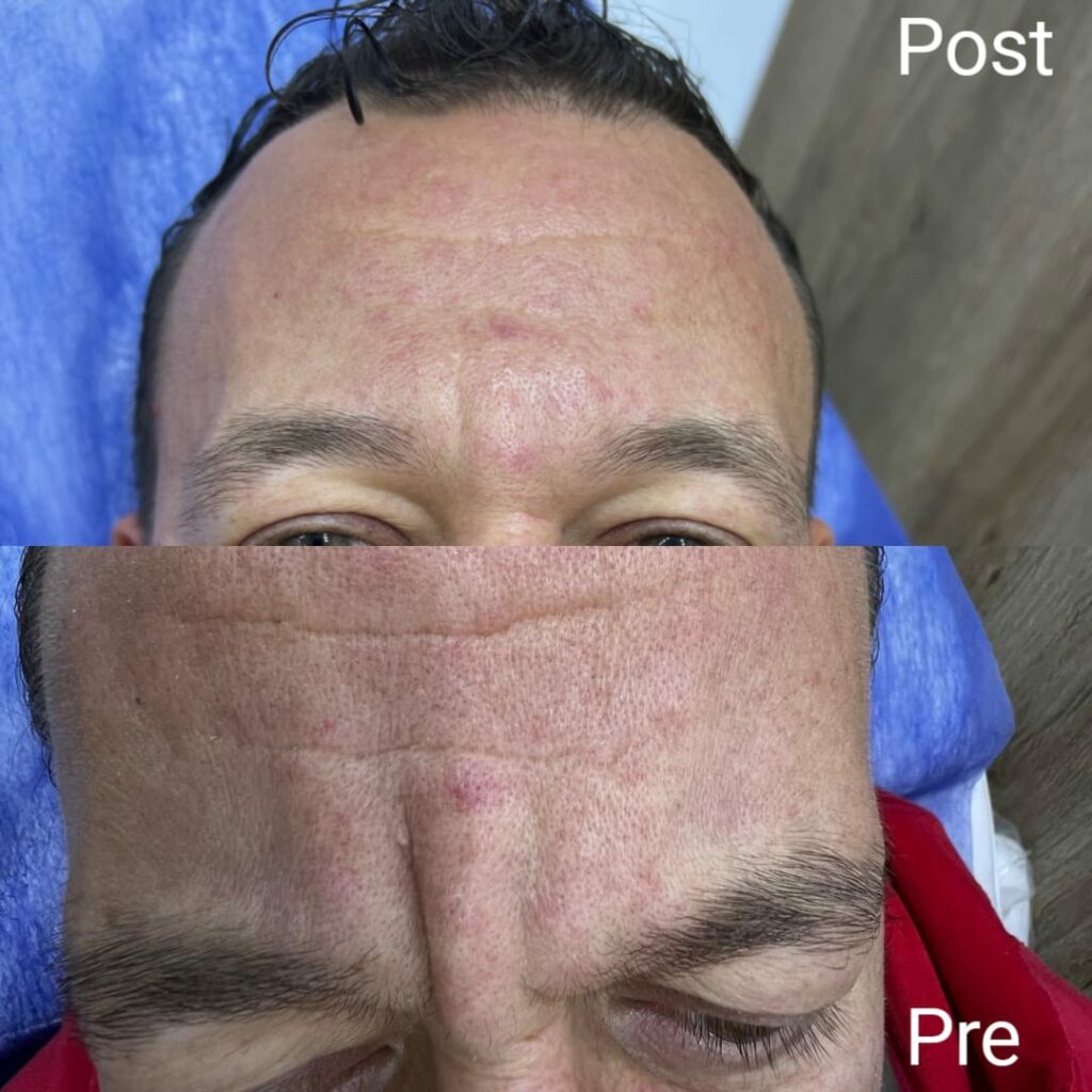 بوتكس تجاعيد الجبهة